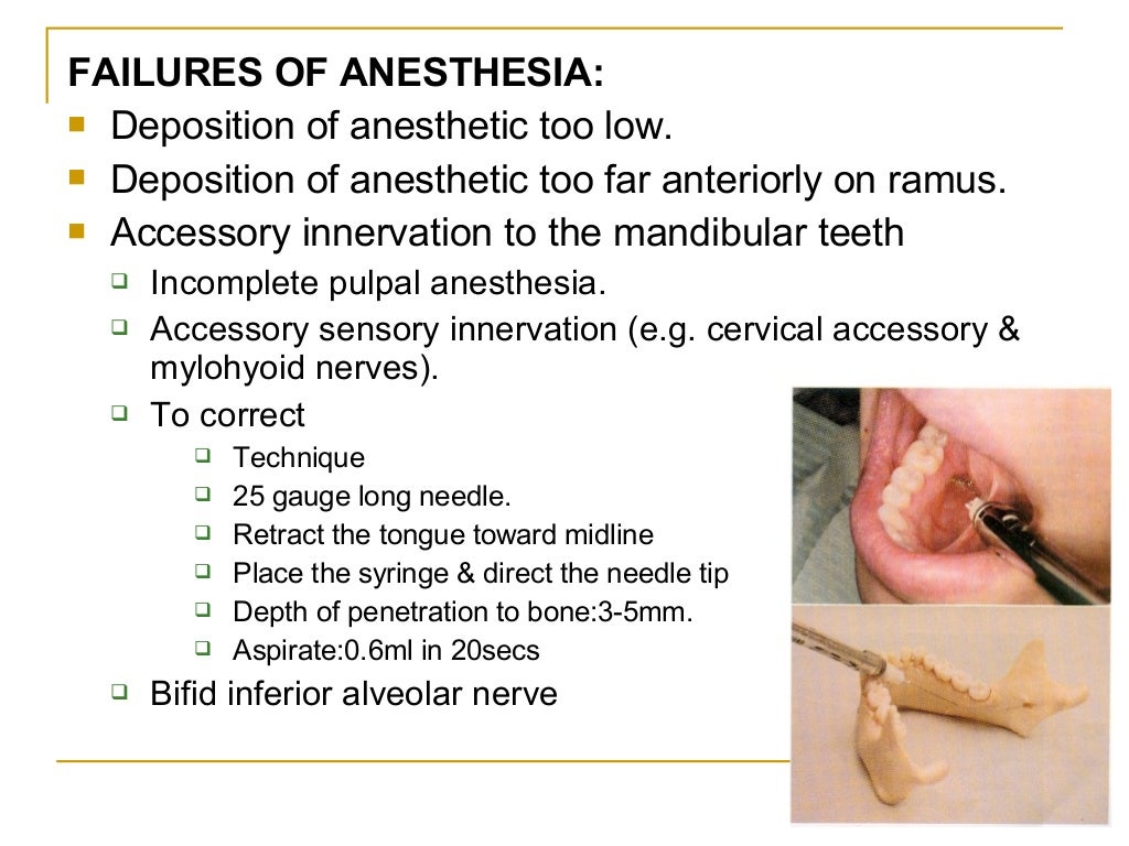 Mandibular Injection Technique