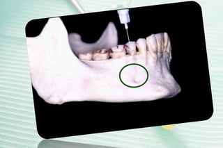 Gow-Gates Mandibular Block
Technique
Coordinate intraoral & extraoral landmarks
Align barrel of syringe over premolars and...