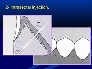 Mandibular Local Anesthesia | PPT