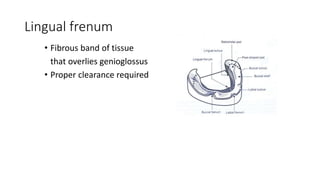 Lingual frenum
• Fibrous band of tissue
that overlies genioglossus
• Proper clearance required
 