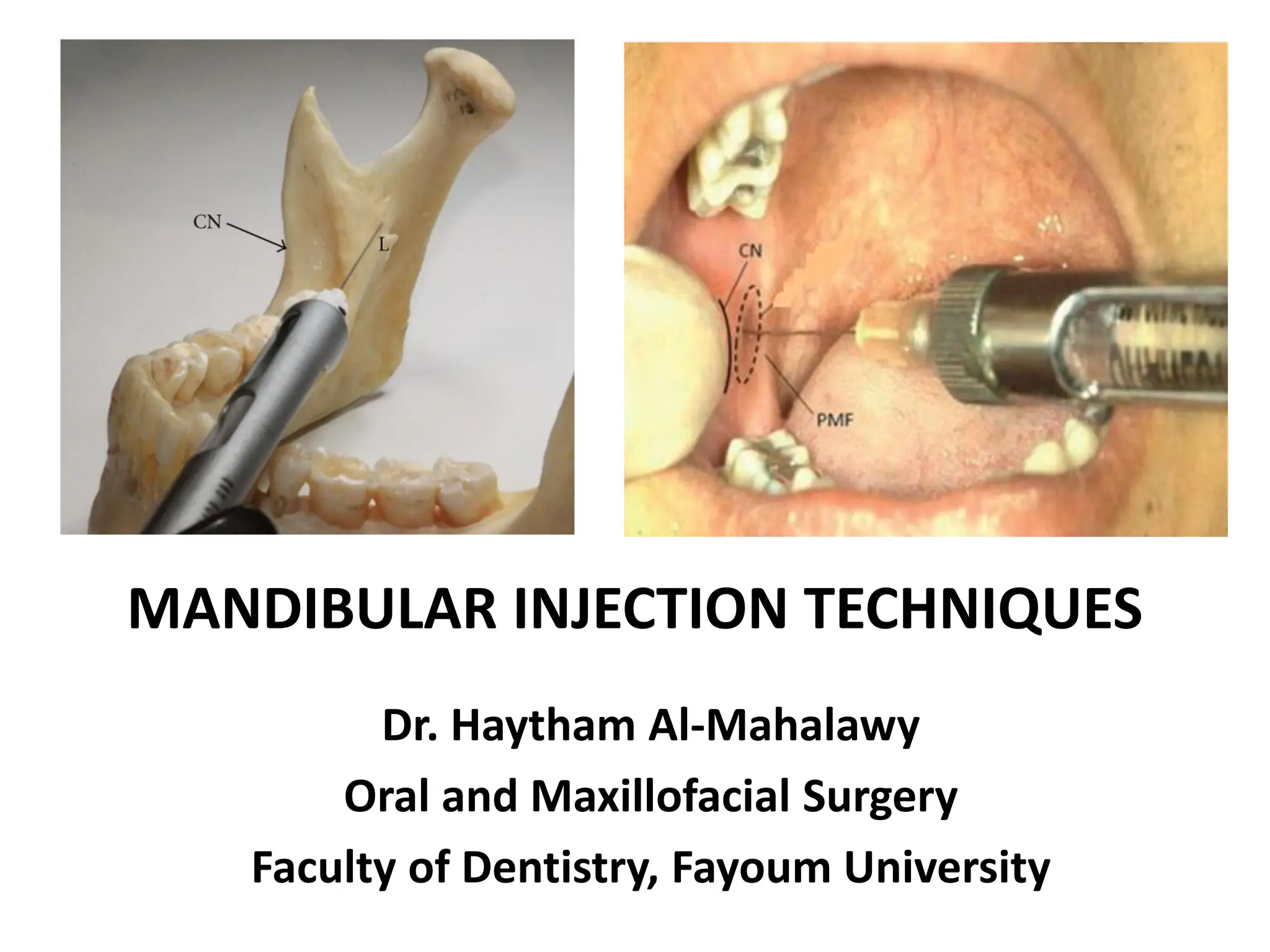 mandibular techniques in your area are here PPT