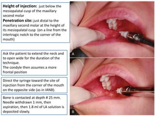 Palatal Injection Method mandibular techniques in your area are here | PDF