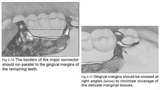 Mandibular major connector _20251004_085247_0000.pptx