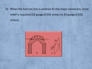 2) When the fulcrum line is anterior to the major connector, more
relief is required (26 guage,0.016 inches to 24 guage,0.020
inches)

 