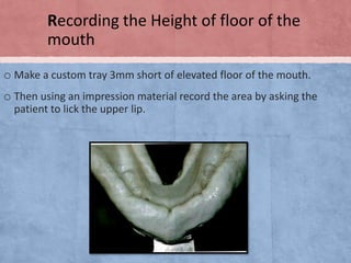Recording the Height of floor of the
mouth
o Make a custom tray 3mm short of elevated floor of the mouth.

o Then using an impression material record the area by asking the
patient to lick the upper lip.

 