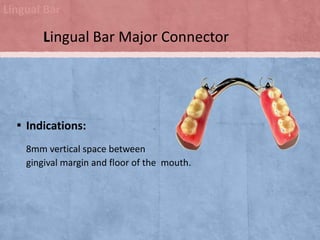Lingual Bar

Lingual Bar Major Connector

▪ Indications:
8mm vertical space between
gingival margin and floor of the mouth.

 