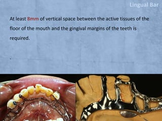 Lingual Bar
At least 8mm of vertical space between the active tissues of the

floor of the mouth and the gingival margins of the teeth is
required.

.

 