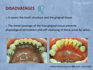 Linguoplate

DISADVATAGES
o It covers the tooth structure and the gingival tissue.
o The metal coverage of the free gingival tissue prevents
physiological stimulation and self-cleansing of these areas by saliva.

British Dental Journal 189, 414 - 424 (2000)

 