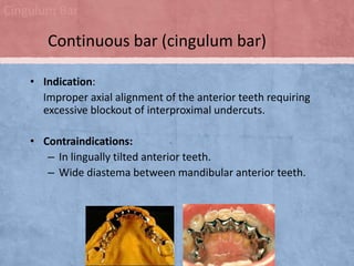 Cingulum Bar

Continuous bar (cingulum bar)
• Indication:
Improper axial alignment of the anterior teeth requiring
excessive blockout of interproximal undercuts.
• Contraindications:
– In lingually tilted anterior teeth.
– Wide diastema between mandibular anterior teeth.

 