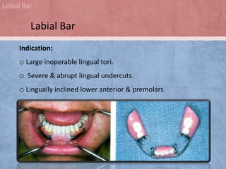 Labial Bar

Labial Bar
Indication:

o Large inoperable lingual tori.
o Severe & abrupt lingual undercuts.
o Lingually inclined lower anterior & premolars.

 