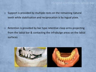 Hinged continuous labial bar
o Support is provided by multiple rests on the remaining natural
teeth while stabilization and reciprocation is by ingual plate.

o Retention is provided by bar type retentive clasp arms projecting
from the labial bar & contacting the infrabulge areas on the labial
surfaces

 