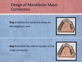 Design of Mandibular Major
Connectors
Step I-Outline the basal seat areas on
the diagnostic cast.

Step II-Outline the inferior border of the
major connector.

 