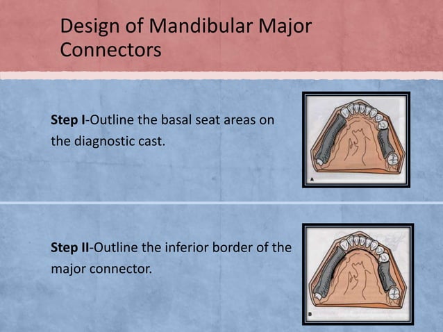Mandibular Major Connectors | PPTX | Dental Health | Diseases and ...