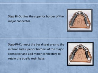 Step III-Outline the superior border of the
major connector.

Step-IV-Connect the basal seat area to the
inferior and superior borders of the major
connector and add minor connectors to
retain the acrylic resin base.

 
