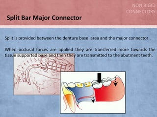 NON RIGID
CONNECTORS

Split Bar Major Connector
Split is provided between the denture base area and the major connector .

When occlusal forces are applied they are transferred more towards the
tissue supported base and then they are transmitted to the abutment teeth.

 