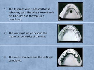 1. The 12 gauge wire is adapted to the
refractory cast. The wire is coated with
die lubricant and the wax up is
completed.

2. The wax must not go beyond the
maximum convexity of the wire.

3. The wire is removed and the casting is
completed.

 