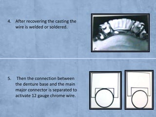 4. After recovering the casting the
wire is welded or soldered.

5.

Then the connection between
the denture base and the main
major connector is separated to
activate 12 gauge chrome wire.

 