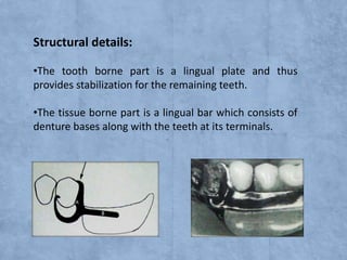 Structural details:
•The tooth borne part is a lingual plate and thus
provides stabilization for the remaining teeth.
•The tissue borne part is a lingual bar which consists of
denture bases along with the teeth at its terminals.

 