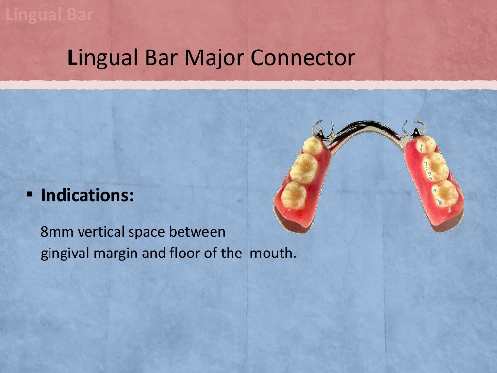 Mandibular Major Connectors