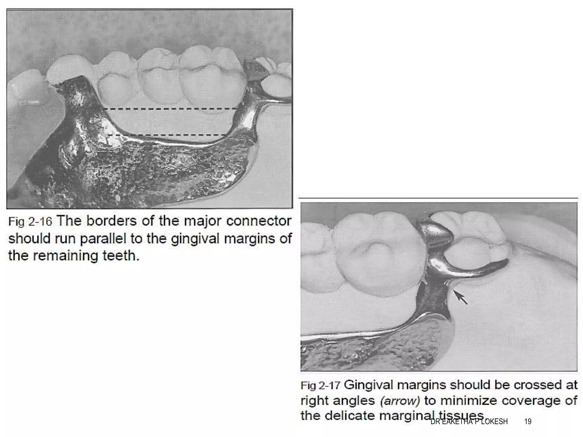 Mandibular major connectors | PPTX