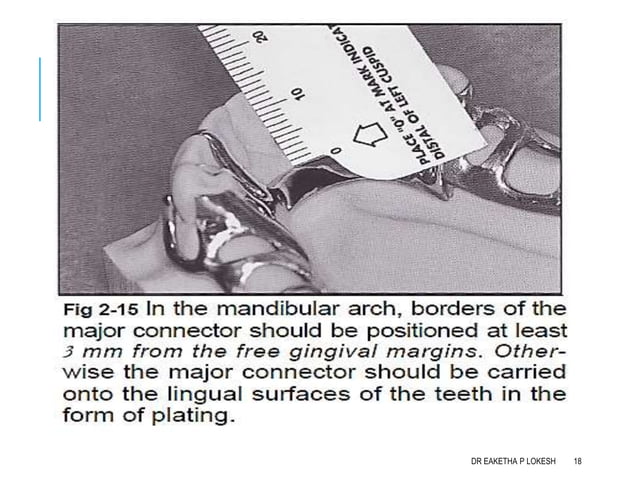 Mandibular major connectors | PPTX | Dental Health | Diseases and ...