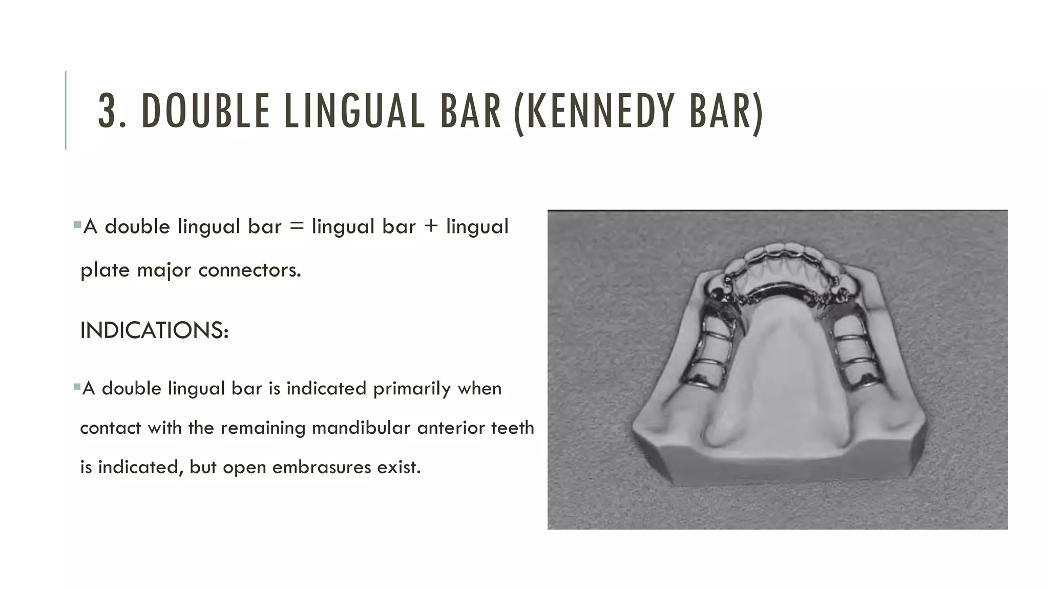 Mandibular Major Connectors | PDF