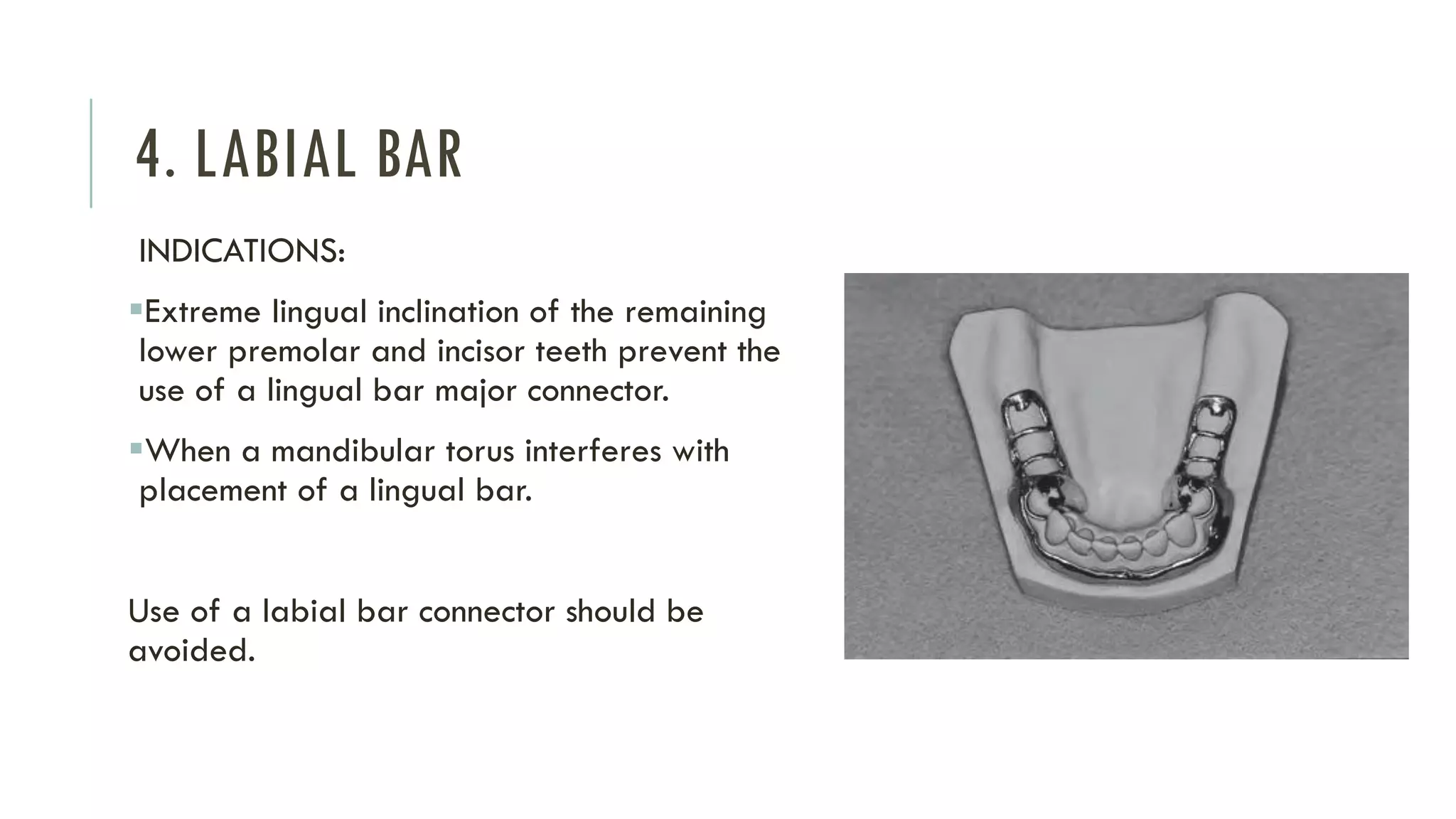Mandibular Major Connectors | PDF