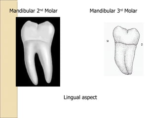 Lingual aspect Mandibular 2 nd  Molar Mandibular 3 rd  Molar 