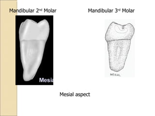 Mesial aspect Mandibular 3 rd  Molar Mandibular 2 nd  Molar 