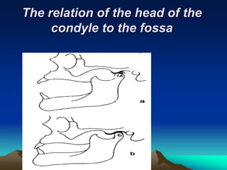 The relation of the head of the
     condyle to the fossa
 