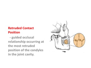 Retruded Contact
Position
- guided occlusal
relationship occurring at
the most retruded
position of the condyles
in the joint cavity.
 