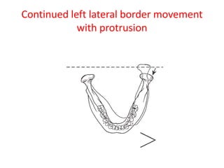 Continued left lateral border movement
with protrusion
 
