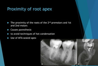 Proximity of root apex
 The proximity of the roots of the 2nd premolars and 1st
and 2nd molars
 Causes paresthesia
 to avoid techniques of hot condensation
 Use of MTA sealed apex
 