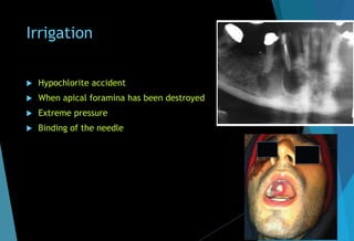 Irrigation
 Hypochlorite accident
 When apical foramina has been destroyed
 Extreme pressure
 Binding of the needle
 