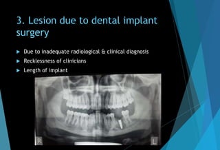 3. Lesion due to dental implant
surgery
 Due to inadequate radiological & clinical diagnosis
 Recklessness of clinicians
 Length of implant
 