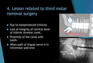 4. Lesion related to third molar
removal surgery
 Due to inexperienced clinician
 Loss of integrity of cortical bone
of inferior alveolar canal.
 Proximity of the canal with
tooth.
 When path of lingual nerve is in
retromolar pad area
 