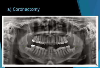 a) Coronectomy
 