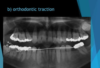 b) orthodontic traction
 
