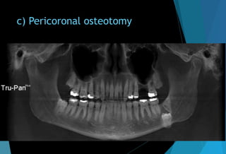 c) Pericoronal osteotomy
 