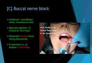 [C] Buccal nerve block
Landmark : mandibular
molar, mucobuccal fold.
Operator position : 8
o’clock & 10 o’clock
Penetrate 2-4 mm bevel
facing downwards.
If aspiration is –ve
deposit 0.3ml/10sec
 