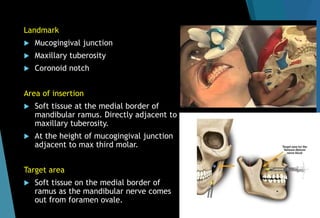 Landmark
 Mucogingival junction
 Maxillary tuberosity
 Coronoid notch
Area of insertion
 Soft tissue at the medial border of
mandibular ramus. Directly adjacent to
maxillary tuberosity.
 At the height of mucogingival junction
adjacent to max third molar.
Target area
 Soft tissue on the medial border of
ramus as the mandibular nerve comes
out from foramen ovale.
 