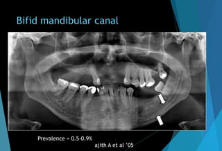 Bifid mandibular canal
Prevalence = 0.5-0.9%
ajith A et al ’05
 