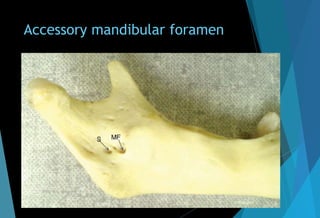 Accessory mandibular foramen
 