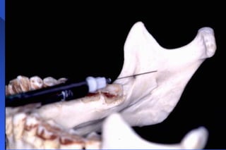 Mandibular nerve block | PPT