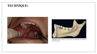 MANDIBULAR NERVE BLOCKS and techniques in dentistry | PPTX