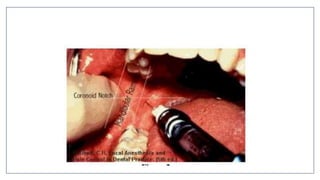 MANDIBULAR NERVE BLOCKS and techniques in dentistry | PPTX