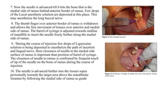 MANDIBULAR NERVE BLOCKS and techniques in dentistry | PPTX