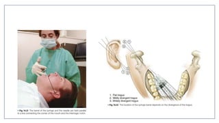 MANDIBULAR NERVE BLOCKS and techniques in dentistry | PPTX