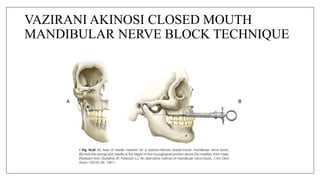 MANDIBULAR NERVE BLOCKS and techniques in dentistry | PPTX
