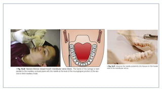 MANDIBULAR NERVE BLOCKS and techniques in dentistry | PPTX